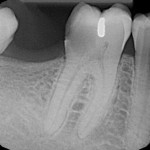 Root canal before and after
